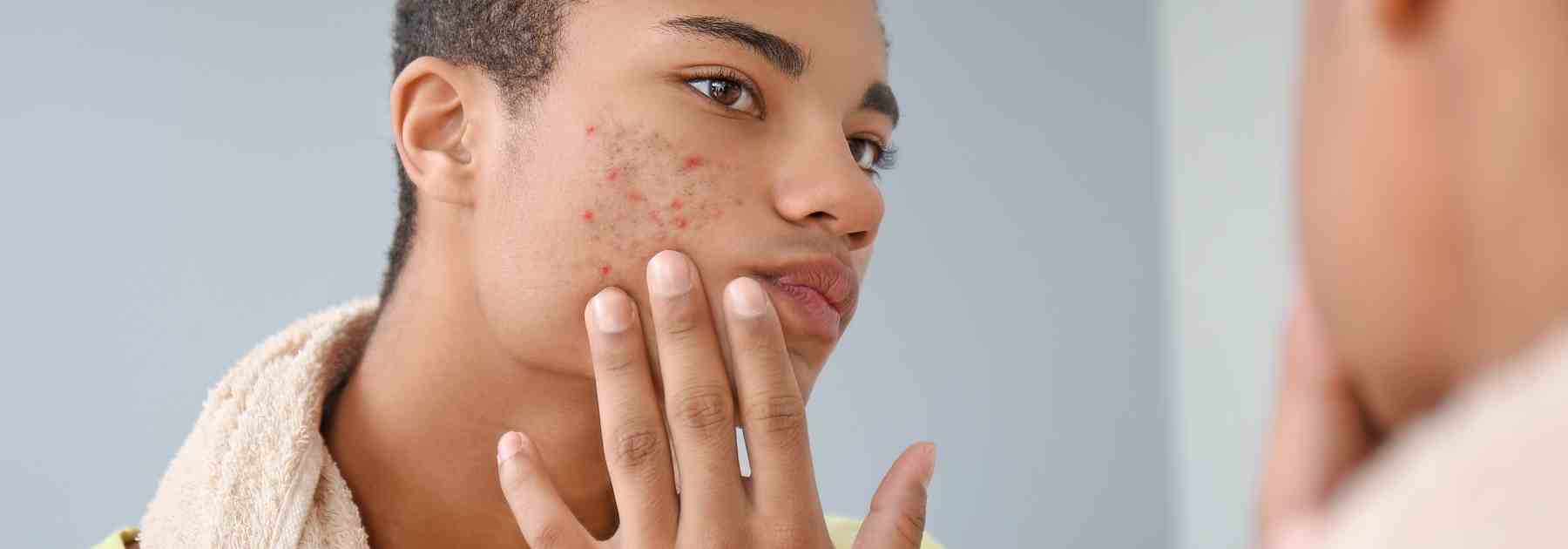 Find treatments for acne prone skin today