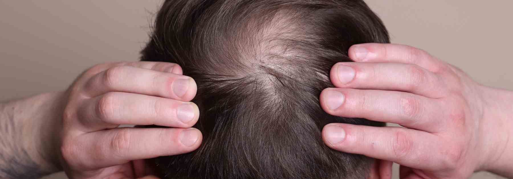Should I use hair loss shampoo or tablets?